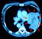 diagnostika-rakoviny-plic-vysetrovaci-metody-rentgen-ct-mr-tumormarkery