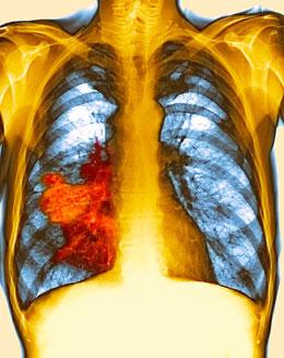 koureni-genove-mutace-rakovina-plic-vyzkum-studie